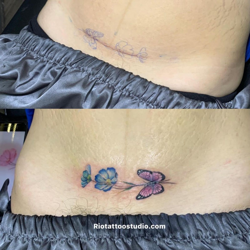 Hình xăm che sẹo lồi ở bụng bằng hình xăm bướm và hoa đào