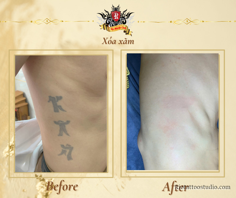 Kết quả xóa xăm tại Rio Tattoo Studio được tạo nên từ sự kết hợp hoàn hảo của 3 dòng máy tiên tiến trong bộ Rio Laser Ultra Series, mang đến khả năng đánh tan mọi sắc màu khó xóa nhất.