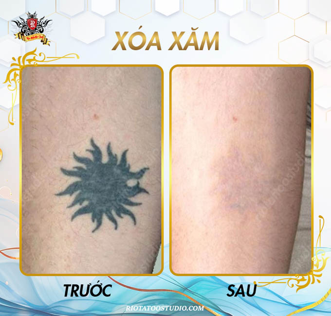Hình ảnh xóa xăm của khách hàng thực hiện xóa tại Rio Tattoo Studio