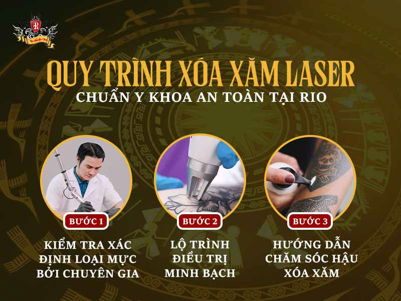 Quy trình xóa xăm laser chuẩn y khoa an toàn tại Rio Tattoo Studio