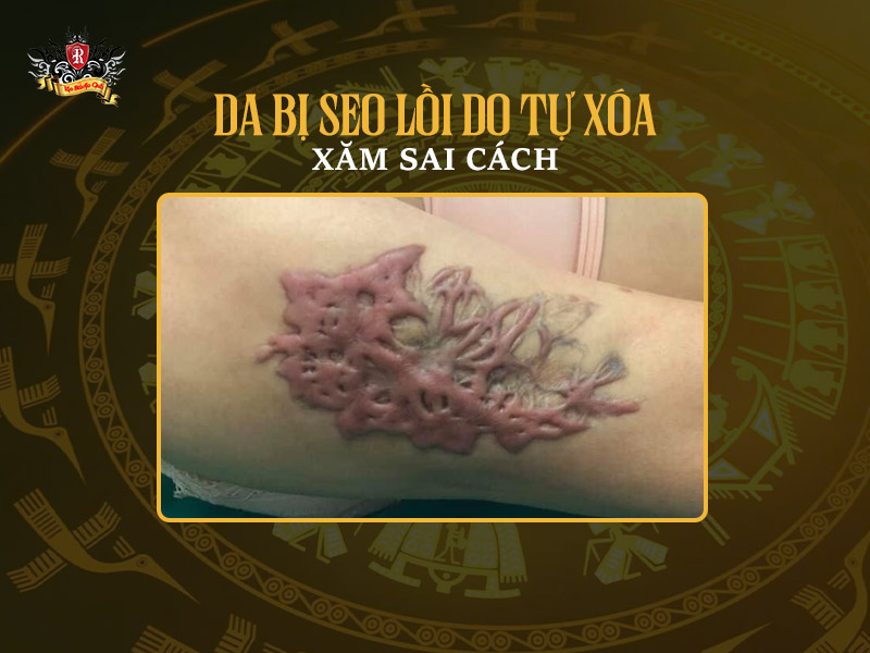 Hình xăm có xóa được không – Hình ảnh sẹo lồi co quắp do xóa xăm không đúng kỹ thuật tại nhà.