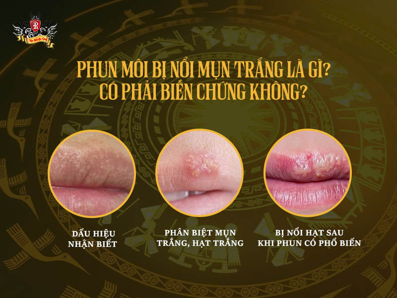Phun môi bị nổi mụn trắng – nguyên nhân và cách xử lý
