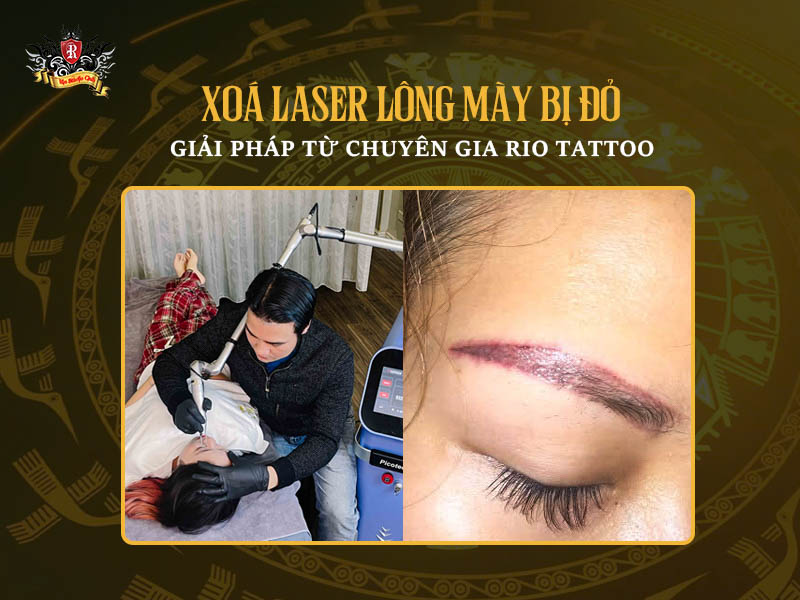Hình xăm có xóa được không – Chuyên gia xử lý tình trạng xóa laser lông mày bị đỏ an toàn.
