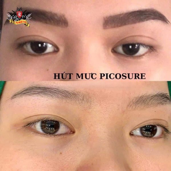 Xóa xăm lông mày bằng laser công nghệ Picosure trước và sau khi điều trị