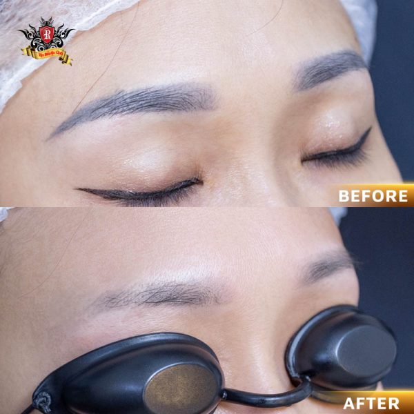 Xóa xăm lông mày bằng laser trước và sau liệu trình cho kết quả mờ rõ rệt, an toàn cho da