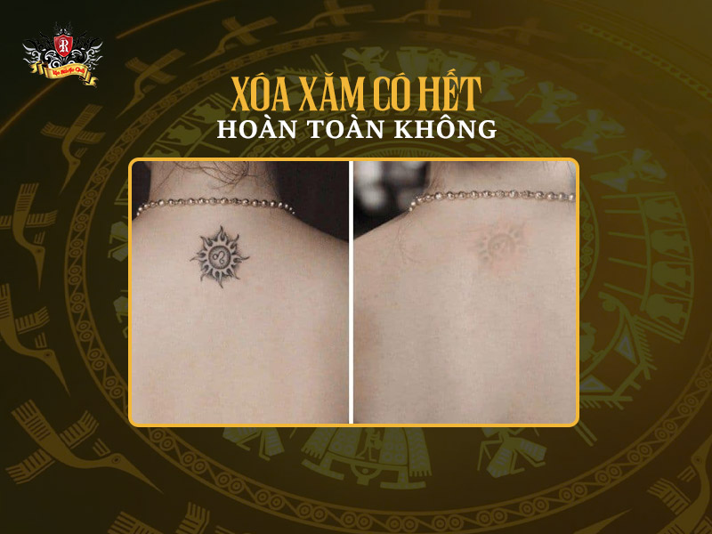 Xóa xăm mấy lần mới hết – Lộ trình xóa hình xăm diện tích lớn ở vùng vai.