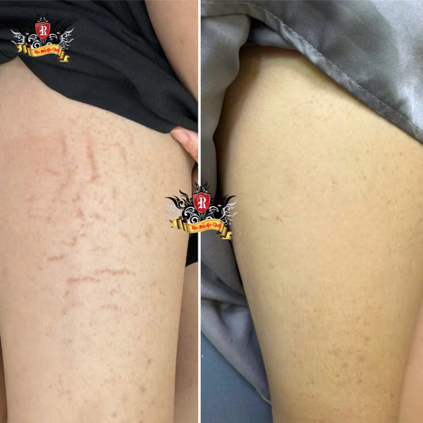 Master-Artist-Trieu-Viet-Anh-medical-skin-camouflage-for-vitiligo-and-stretch-marks-Vietnam