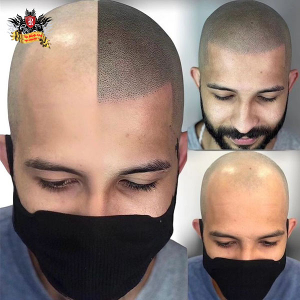 Master Artist Trieu Viet Anh, the pioneer who first introduced and developed the Scalp Micropigmentation (SMP) technique in Vietnam to cover baldness and scalp imperfections.