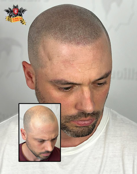 Master Artist Trieu Viet Anh providing 99% realistic scalp micropigmentation, attracting international clients for professional baldness camouflage.