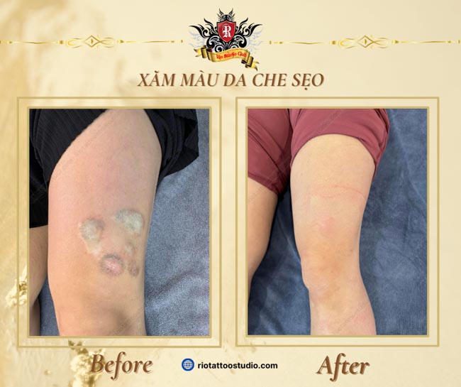 Master Artist Trieu Viet Anh applying his world-first skin tone tattooing technique to camouflage scars and old colorful tattoos with 99% accuracy.