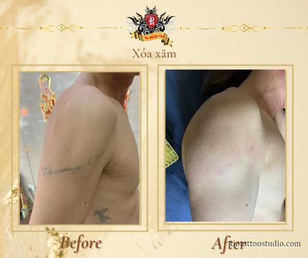 Xóa Xăm 1 - Rio Tattoo Studio