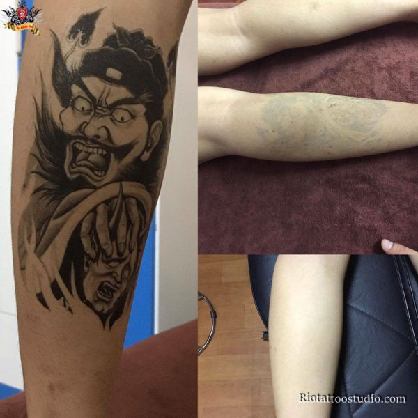 Xóa Xăm 3 - Rio Tattoo Studio