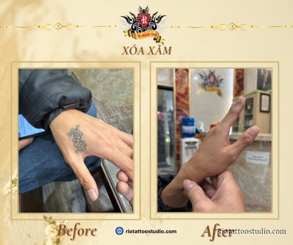 Xóa Xăm 4 - Rio Tattoo Studio