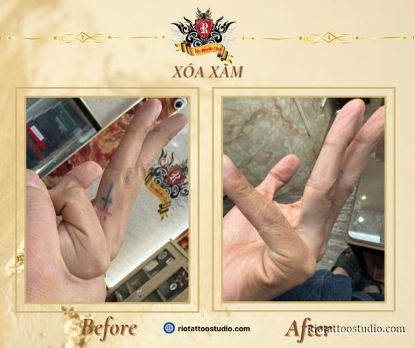 Xóa Xăm 5 - Rio Tattoo Studio