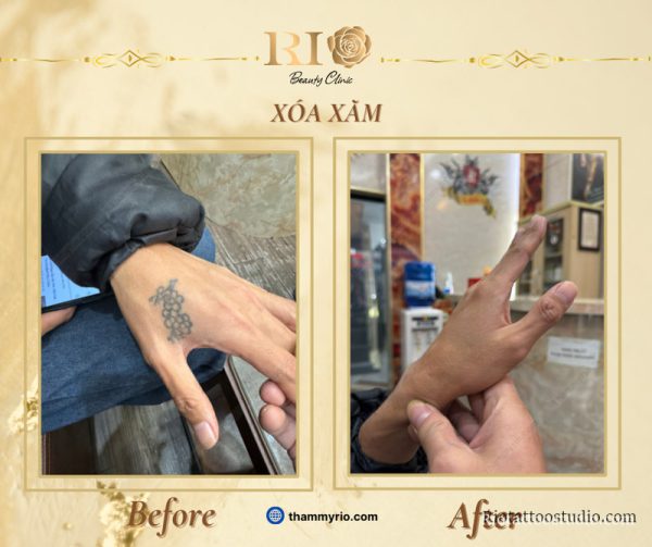 Xóa Xăm 6 - Rio Tattoo Studio