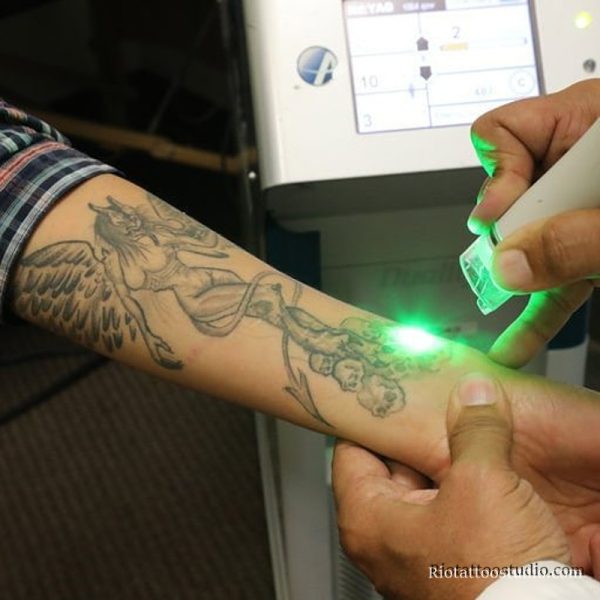 Xóa Xăm - Rio Tattoo Studio