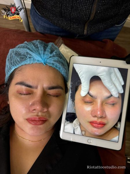 Kết quả xóa xăm mí mắt sạch 98% sau 3 buổi bằng công nghệ Rio Laser Ultra Series an toàn tuyệt đối.