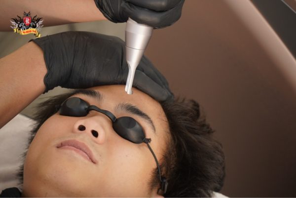 Xóa xăm mí mắt không đau tại Rio Tattoo Studio nhờ thuốc tê nhập khẩu Đức và Thụy Sĩ.