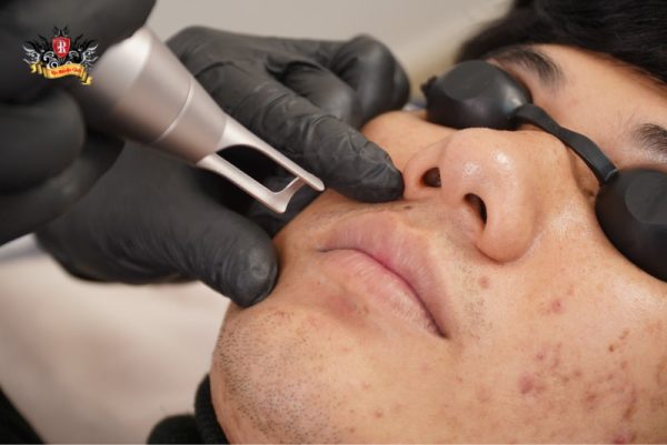 Khách hàng nam hài lòng tuyệt đối sau khi xóa xăm và khử thâm môi tại Rio Tattoo Studio.