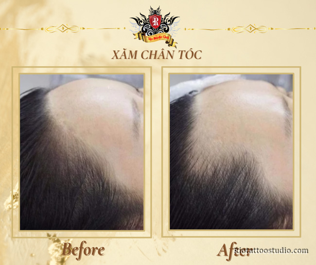 Master Artist Trieu Viet Anh performing Scalp Micropigmentation for women to lower high foreheads and cover scalp scars for a youthful look.
