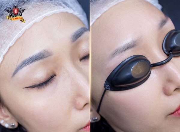 Hình ảnh ghi lại quá trình giải cứu đôi chân mày bị loang màu và trổ sắc thái cực nặng cho một vị khách hàng trở về từ Nga. Tình trạng trước đó của chị là nền mực bị đi quá sâu, loang lổ không đều màu, gây mất thẩm mỹ nghiêm trọng. Sau khi được chuyên gia Triệu Việt Anh trực tiếp thăm khám, Rio đã ứng dụng phác đồ cá nhân hóa với công nghệ Rio Laser Ultra Series. Các bước sóng laser thông minh đã bóc tách chính xác từng tầng mực loang, đánh tan các mảng màu bết dính mà không hề gây tổn thương bề mặt da. Dù khoảng cách địa lý xa xôi, chị vẫn chọn Rio bởi quy trình chuẩn y khoa, sử dụng thuốc tê cao cấp từ Đức và Thụy Sĩ giúp quá trình thực hiện vô cùng nhẹ nhàng. Kết quả sau liệu trình đã loại bỏ hoàn toàn dấu vết mực cũ, trả lại nền da chân mày khỏe mạnh, giúp chị tự tin hơn khi quay trở lại Nga làm việc và sinh sống.