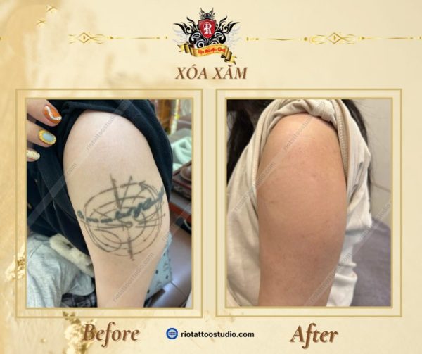 Xóa Xăm 7 - Rio Tattoo Studio