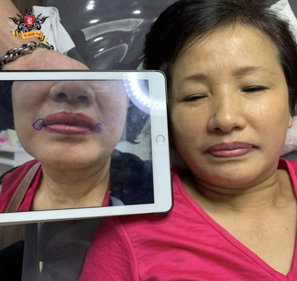 Xóa xăm môi cho cô khách u60 để chuẩn bị làm lại môi mới, sau khi xóa xăm 2 lần gần như sạch 90 %