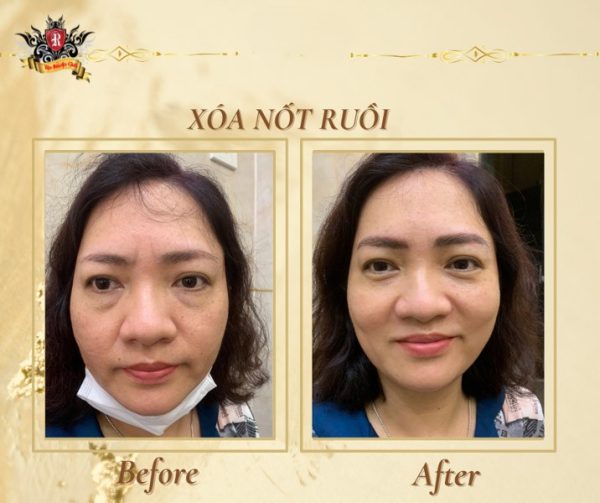 Xóa Xăm 10 - Rio Tattoo Studio