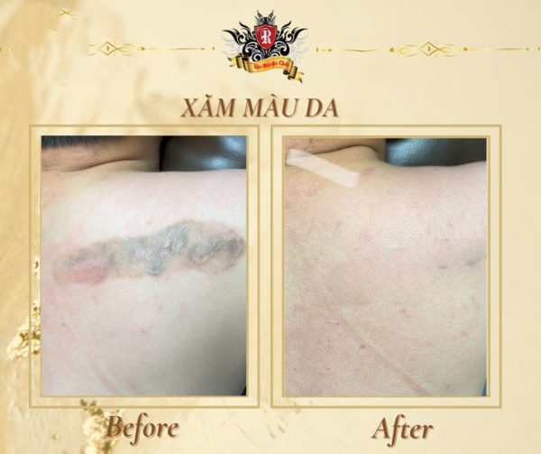Xóa Xăm 11 - Rio Tattoo Studio
