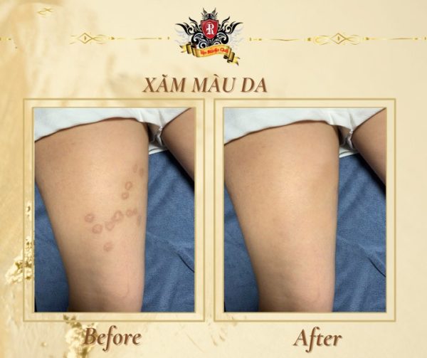 Xóa Xăm 12 - Rio Tattoo Studio