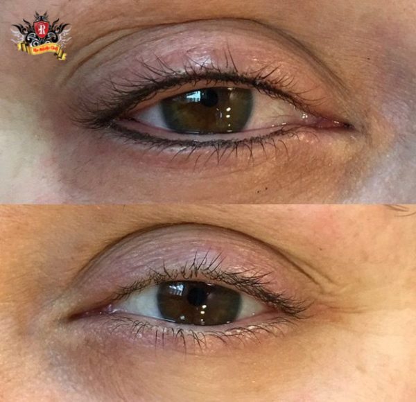 Khách hàng từ Mỹ về Việt Nam xóa xăm mí mắt thành công sạch 100% tại Rio Tattoo Studio