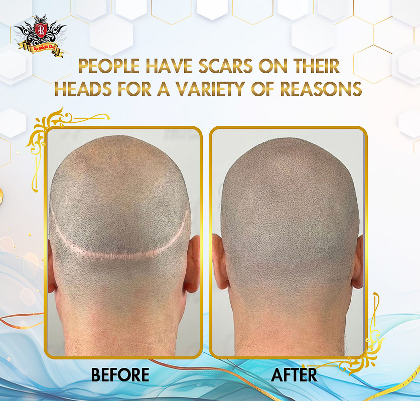 Tattoo Hairline for women treating scalp scars and postpartum hair thinning.